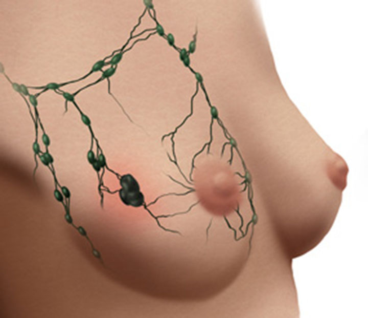 breast cancer signs, breast cancer, breast cancer symptoms