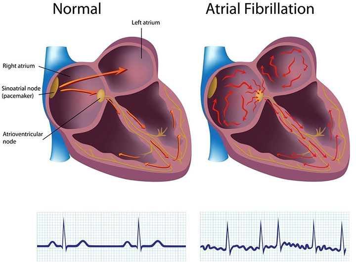 afib, atrial fibrillation, afib treatment