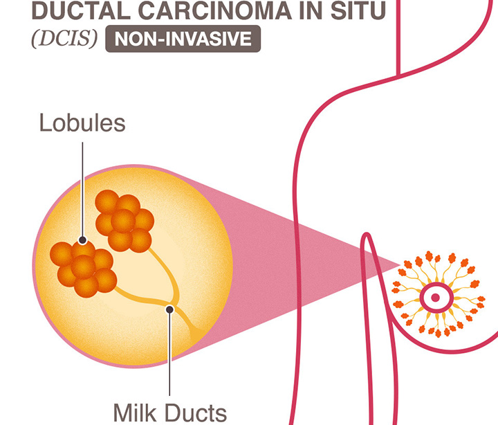stages of breast cancer, breast cancer, breast cancer treatment, types of breast cancer