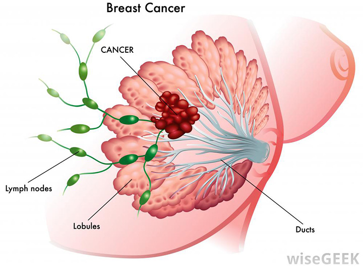 stages of breast cancer, breast cancer, breast cancer treatment, types of breast cancer