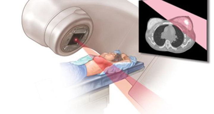 metastatic breast cancer treatments, metastatic breast cancer, stage 4 breast cancer, metastatic breast cancer treatment