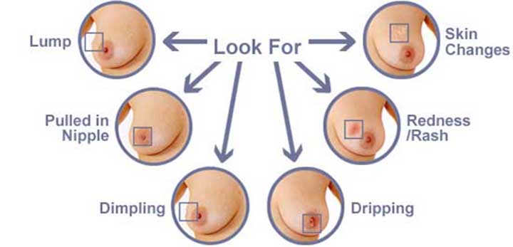 triple negative breast cancer, breast cancer, breast cancer symptoms, breast cancer treatment