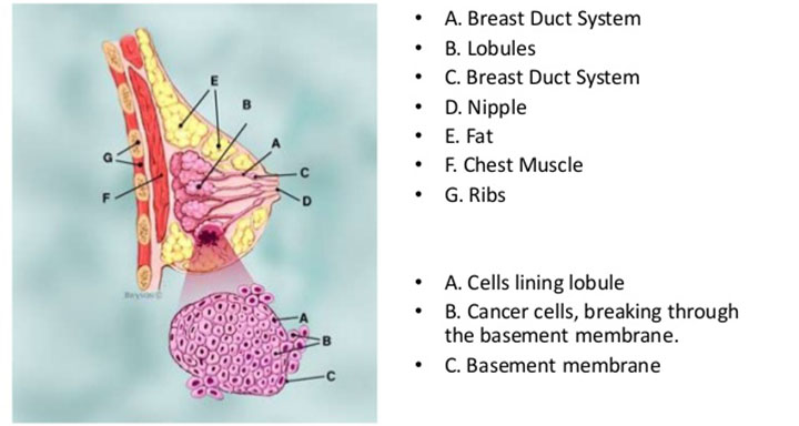 invasive lobular carcinoma, breast cancer, breast cancer treatment