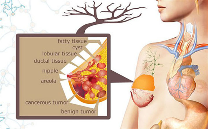 metastatic breast cancer, metastatic breast cancer life expectancy, metastatic breast cancer treatment