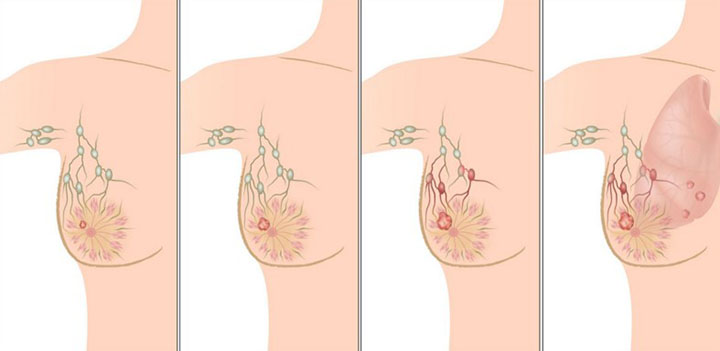 metastatic breast cancer, metastatic breast cancer life expectancy, metastatic breast cancer treatment