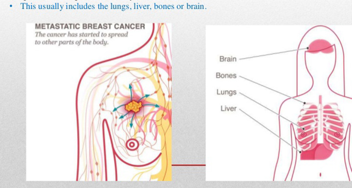 stage IV breast cancer, metastatic breast cancer, stage 4 breast cancer, stage 4 breast cancer symptoms