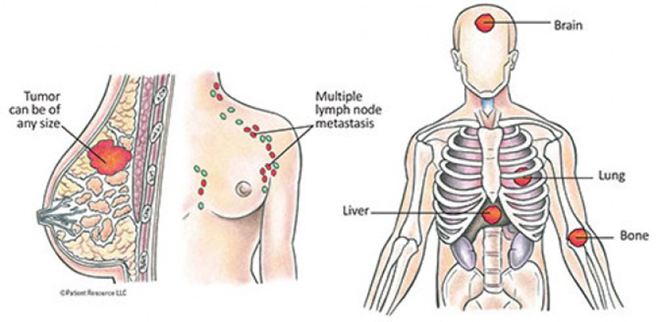 breast cancer statistics, metastatic breast cancer, metastatic breast cancer symptoms
