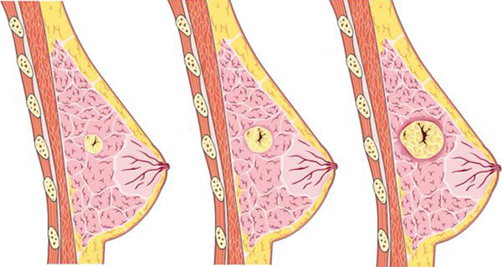 breast cancer statistics, metastatic breast cancer, metastatic breast cancer symptoms