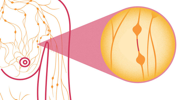 inflammatory breast cancer, breast cancer symptoms, breast cancer signs, skin dimpling