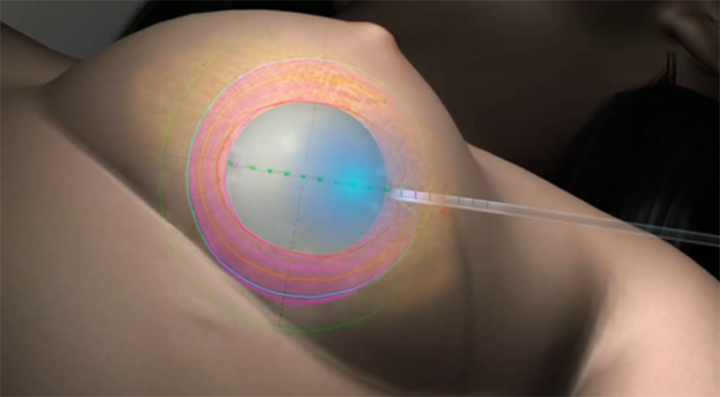 breast cancer recurrence, stage 4 breast cancer, stage 4 breast cancer treatment, metastasized breast cancer