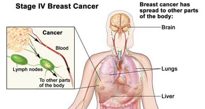 breast cancer recurrence, stage 4 breast cancer, stage 4 breast cancer treatment, metastasized breast cancer