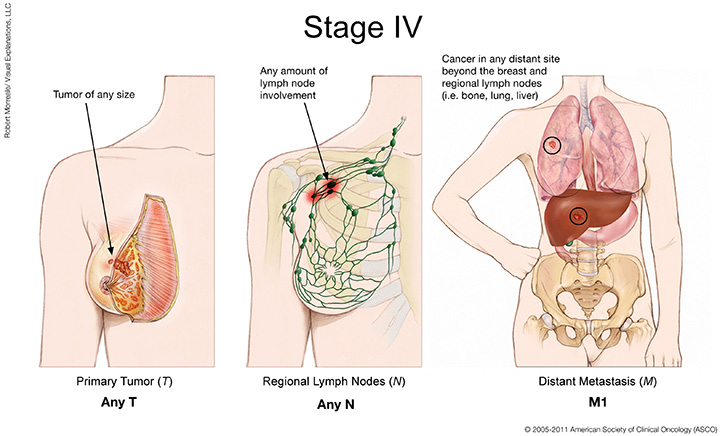 stage 4 breast cancer, metastatic breast cancer, how does breast cancer spread