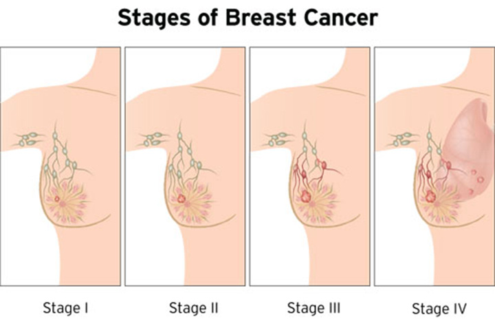 stage 4 breast cancer, metastatic breast cancer, how does breast cancer spread