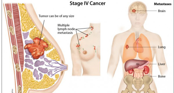 stage 4 breast cancer, metastatic breast cancer, how does breast cancer spread
