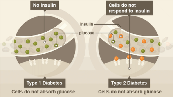 type 2 diabetes, type 2 diabetes symptoms, type 1 diabetes, difference between type 1 and type 2 diabetes