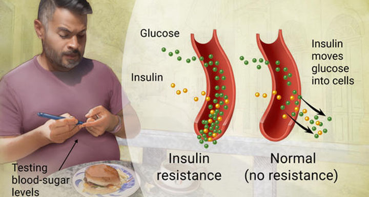 type 2 diabetes, diabetes causes, diabetes symptoms