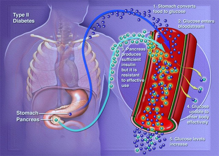 type 2 diabetes mellitus, American diabetes association, type 2 diabetes symptoms