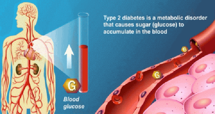 type 2 diabetes mellitus, American diabetes association, type 2 diabetes symptoms