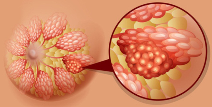breast cancer metastasis, metastasized breast cancer, how does breast cancer spread