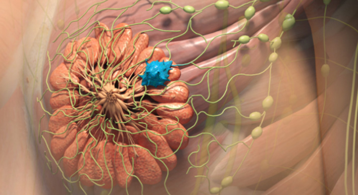 breast cancer metastasis, metastasized breast cancer, how does breast cancer spread