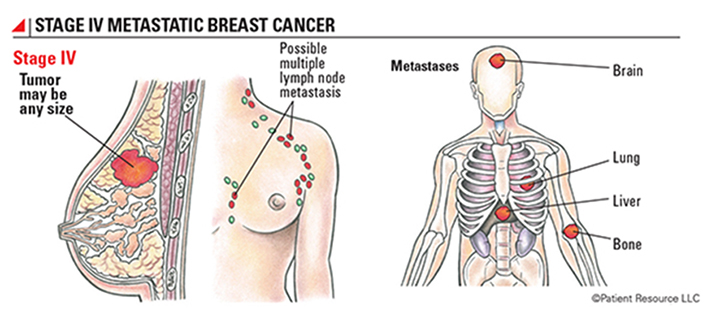 breast cancer metastasis, metastasized breast cancer, how does breast cancer spread