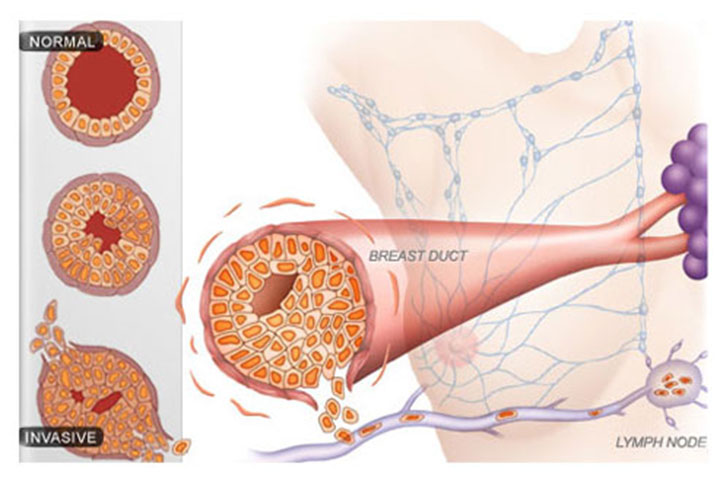metastatic breast cancer, metastatic breast cancer treatment, metastasized breast cancer