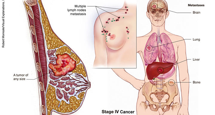 metastatic breast cancer, metastatic breast cancer treatment, metastasized breast cancer