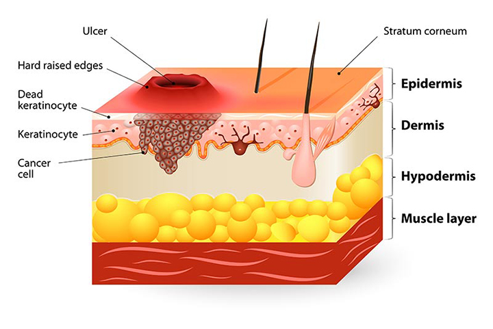 how does breast cancer spread, breast cancer, metastatic breast cancer
