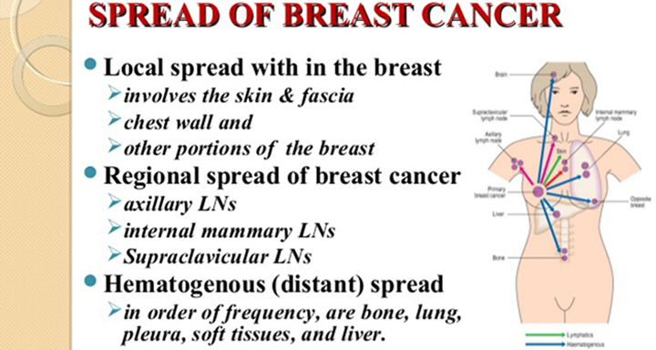 how does breast cancer spread, breast cancer, metastatic breast cancer