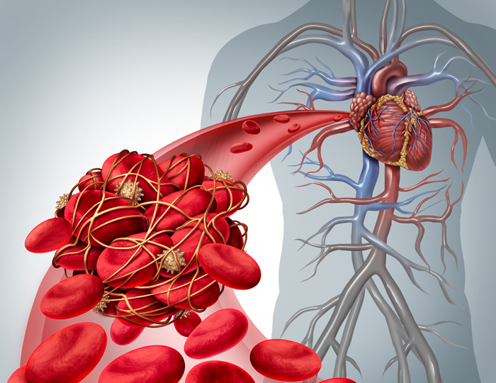 AFib causes, AFib, atrial fibrillation