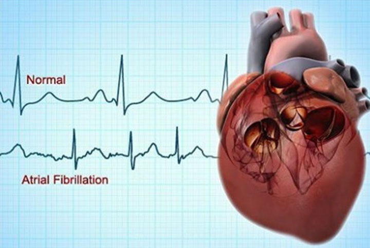 AFib, atrial fibrillation, afib treatment, kidney disease