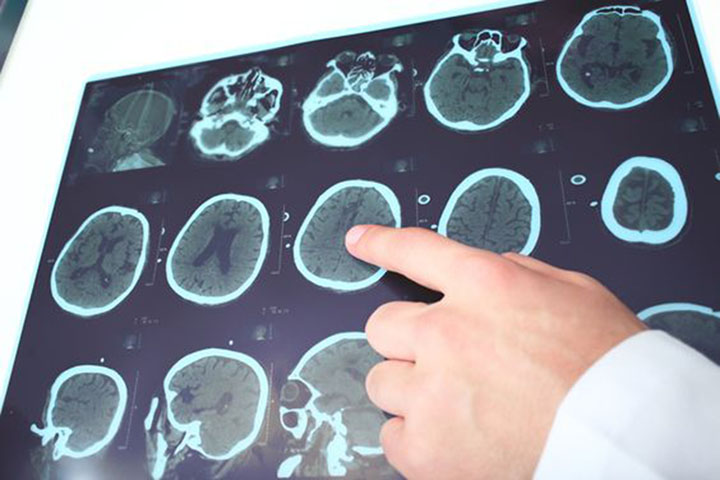 Types of Epileptic Seizures, epileptic seizures, tonic seizure, clonic seizure, tonic-clonic seizure