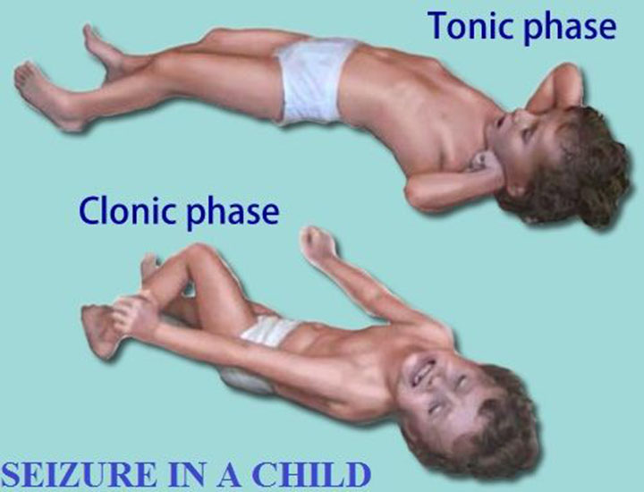 Types of Epileptic Seizures, epileptic seizures, tonic seizure, clonic seizure, tonic-clonic seizure