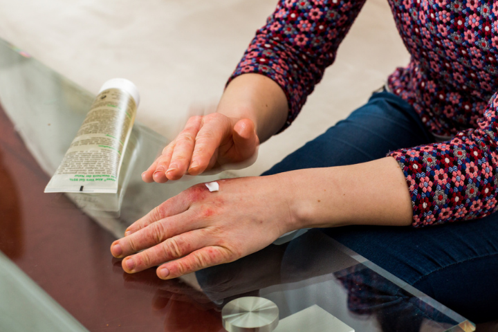 Atopic Dermatitis Eczema Treatments