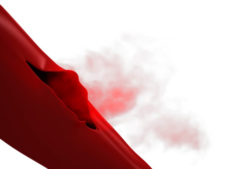 Hemophilia A Treatment
