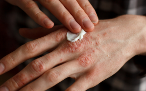 Eczema Ointment