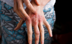 Dupixent Dupilumab Eczema Treatments