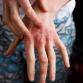 Dupixent Dupilumab Eczema Treatments