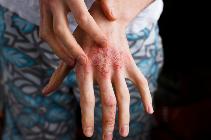 Dupixent Dupilumab Eczema Treatments